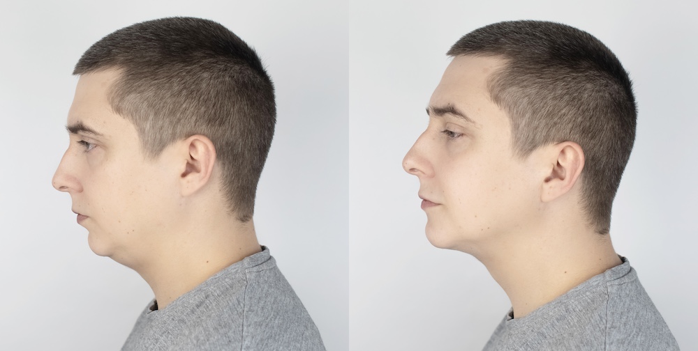 Double,Chin,Lift.,Before,And,After,Plastic,Surgery,,Mentoplasty,Or