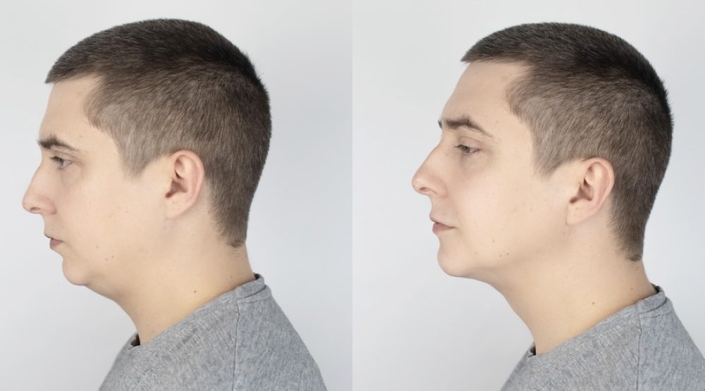 Double,Chin,Lift.,Before,And,After,Plastic,Surgery,,Mentoplasty,Or